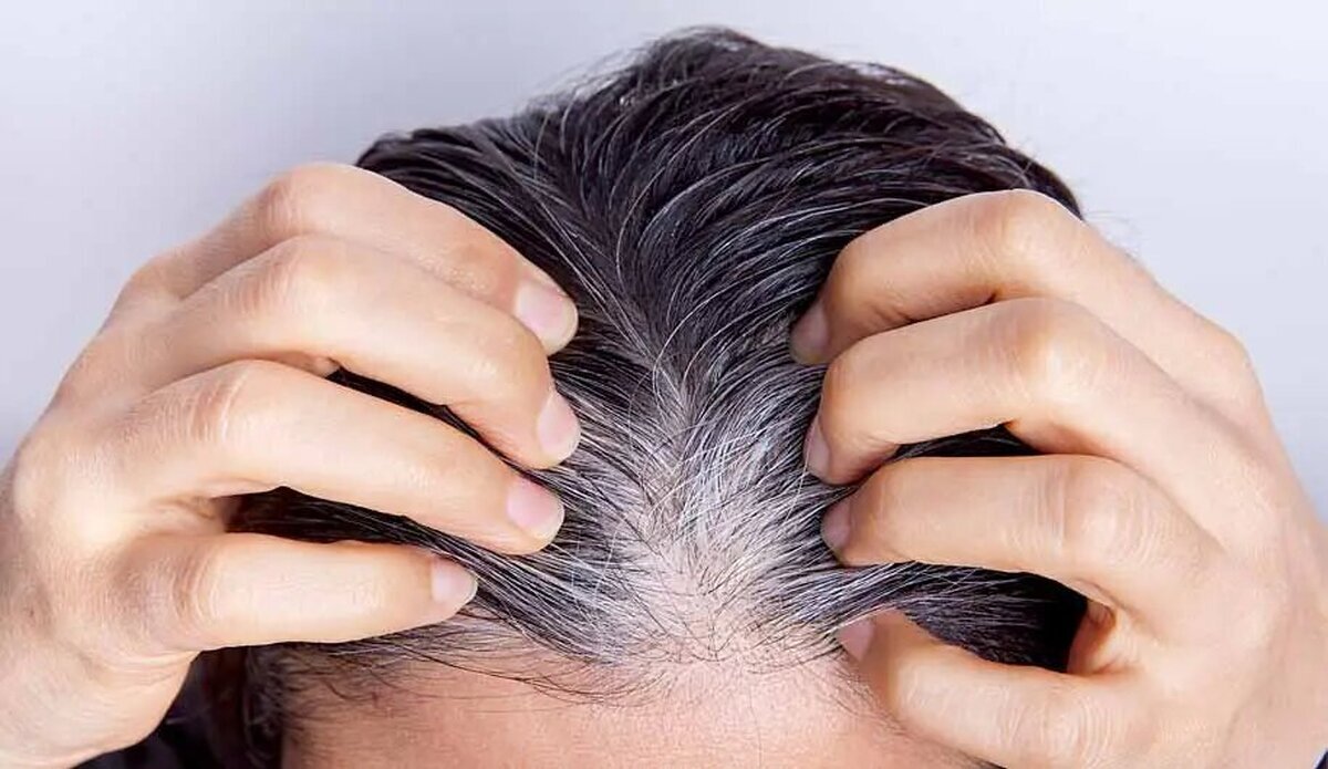 قرص رفع سفیدی مو