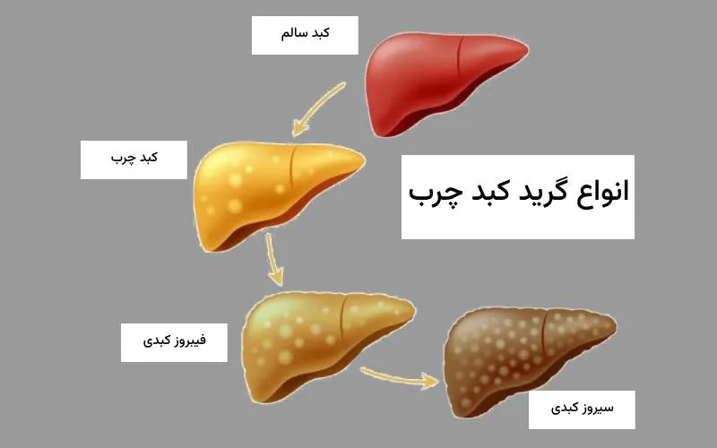 برای پاکسازی کبد چرب چی بخوریم | ایران رژیم برای پاکسازی کبد چرب چی بخوریم