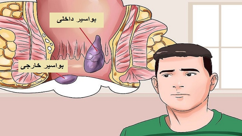 وازلین برای درمان بواسیر