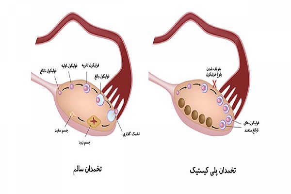 آیا تنبلی تخمدان باعث نازایی میشود؟