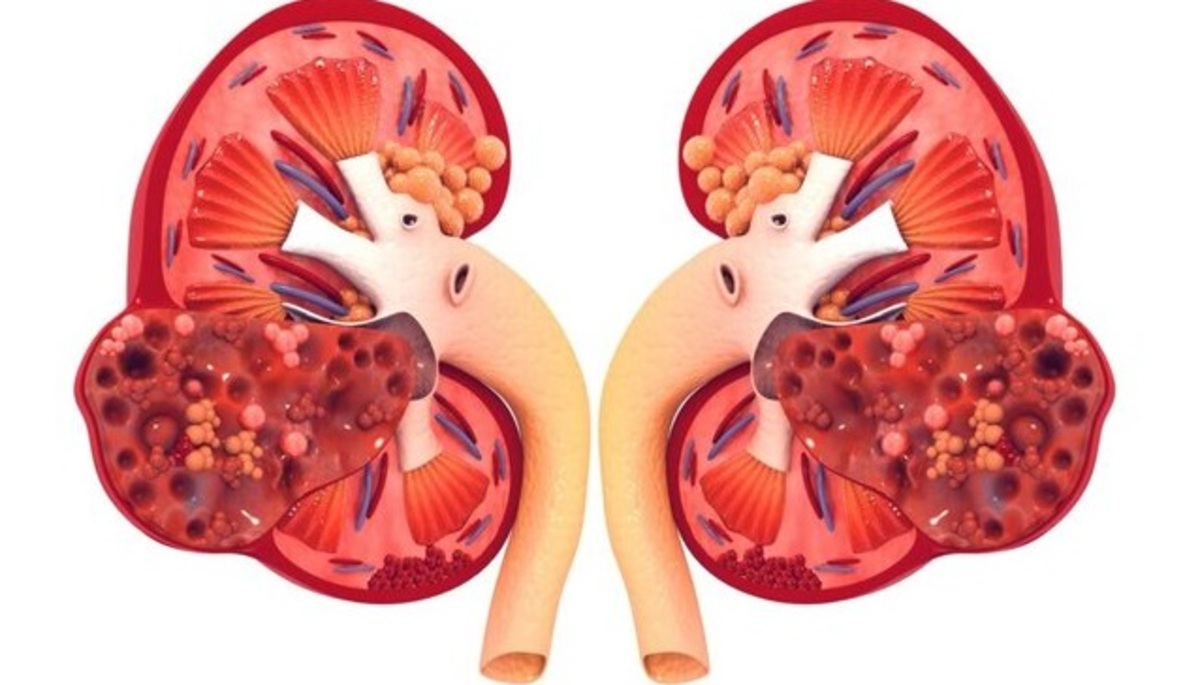 رژیم کم پتاسیم بعد از پیوند کلیه